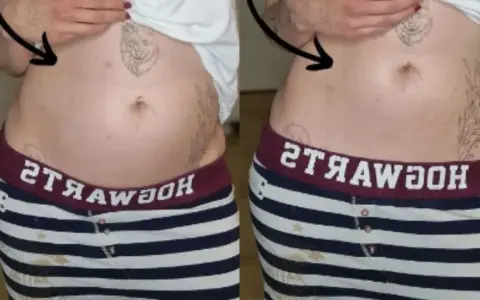 Porównanie brzucha: po lewej widoczne wzdęcia, po prawej płaski. Endometrioza jak wygląda? Czasem tak.