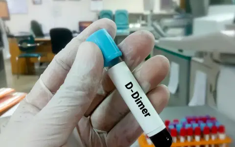 Rękawiczka trzyma probówkę z napisem "D-Dimer". W tle laboratorium, gdzie można dowiedzieć się, d-dimery jak obniżyć.