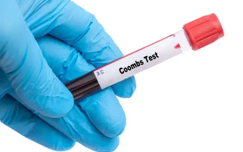 Rękawiczka w niebieskiej rękawiczce trzyma probówkę z krwią do badania. Na etykiecie widnieje napis "Coombs Test", kluczowy dla oceny odczynu Coombsa w ciąży.