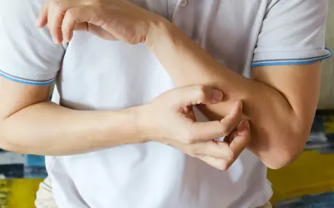 Dłoń drapiąca przedramię, mogące być jednym z objawów skórnych HIV.