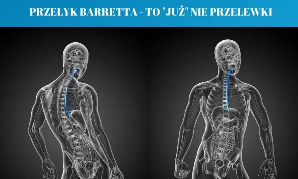 Przełyk Barretta objawy: schematyczne sylwetki ludzkie ukazujące przełyk. Po lewej widok z tyłu, po prawej z przodu.