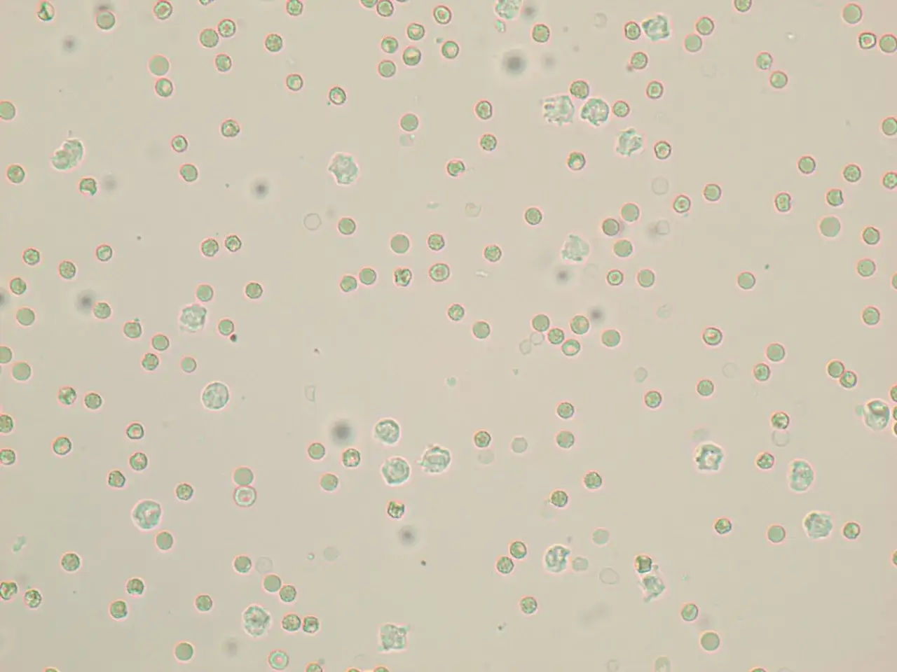 Widoczne liczne nabłonki okrągłe w moczu, niektóre z widocznymi fragmentami cytoplazmy.