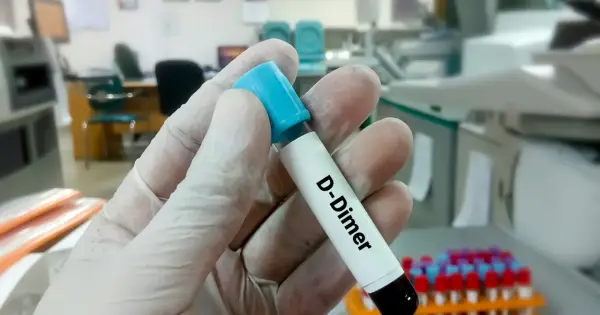 Rękawiczka trzyma probówkę z napisem "D-Dimer". W tle laboratorium, gdzie można dowiedzieć się, d-dimery jak obniżyć.